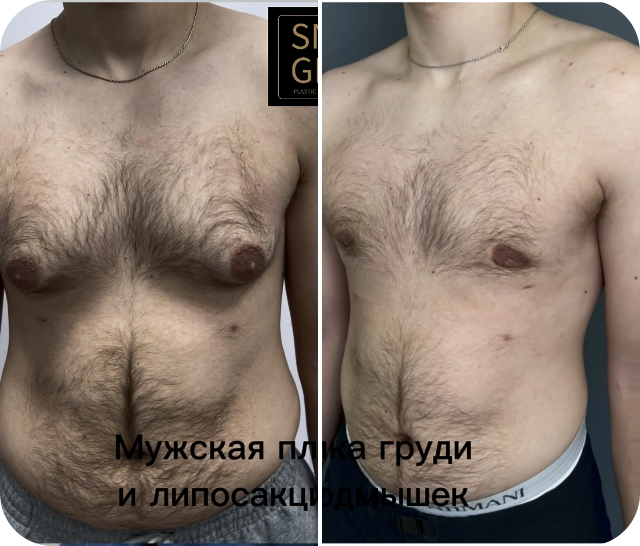 Удаление гинекомастии — до и после