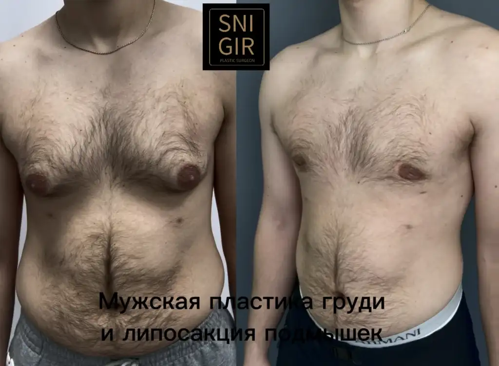 Гинекомастия и липосакция подмышечных зон — сравнение до и после операции, ракурс 1